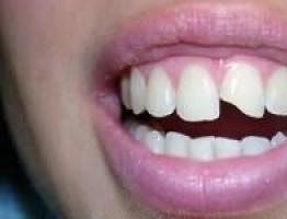 Сломанный зуб во сне что означает